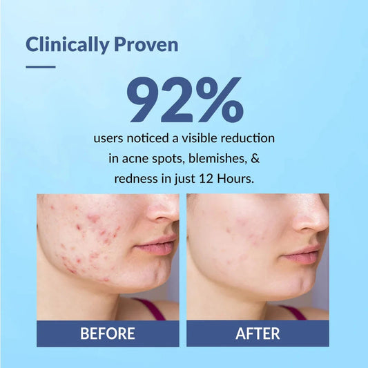 Fixderma Salyzap Acne Spot Corrector Gel