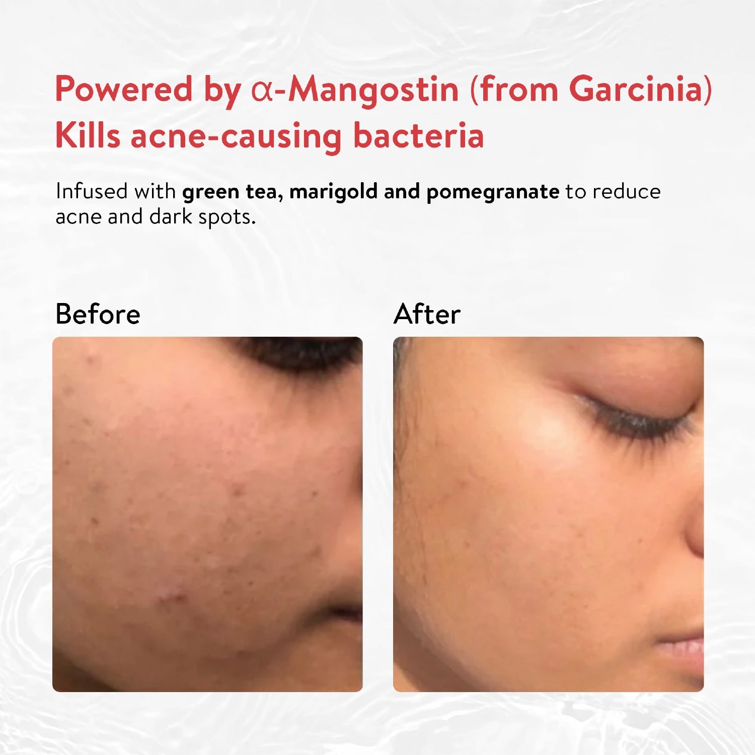 Acne Enemy Face Wash Gel for Acne & Pimples | Fights Acne-Causing Bacteria & Excess Oil | With Alpha-CURe Complex, Garcinia & Manjistha | Sulfate-Free Gel Cleanser | For Acne-Prone Skin | Net Qty- 100 ml - Single 100ml
