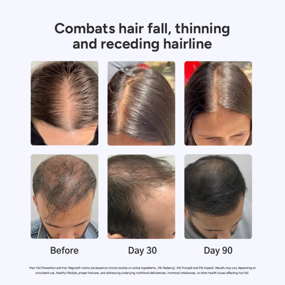 Intensive Hair Growth Serum: Buy 2, Get 1 Free + Free Derma Roller 