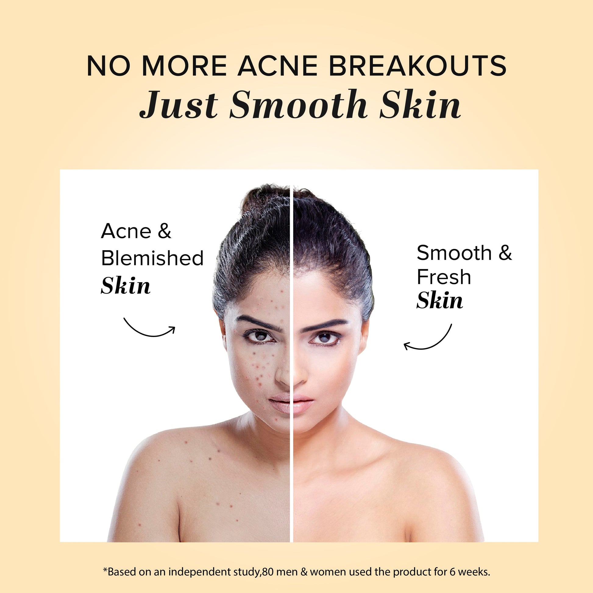 Herbal Acne Pimple Cream 50gm