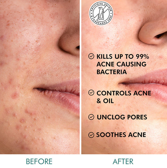 2% Salicylic Acid Serum-Acne Pads with Matcha Tea - 40 N