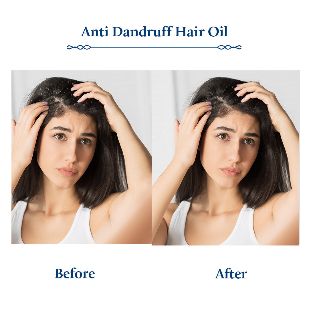 Briganantadi Tea Tree Anti Dandruff Oil for Hair | Clean & Healthy Scalp 200ml