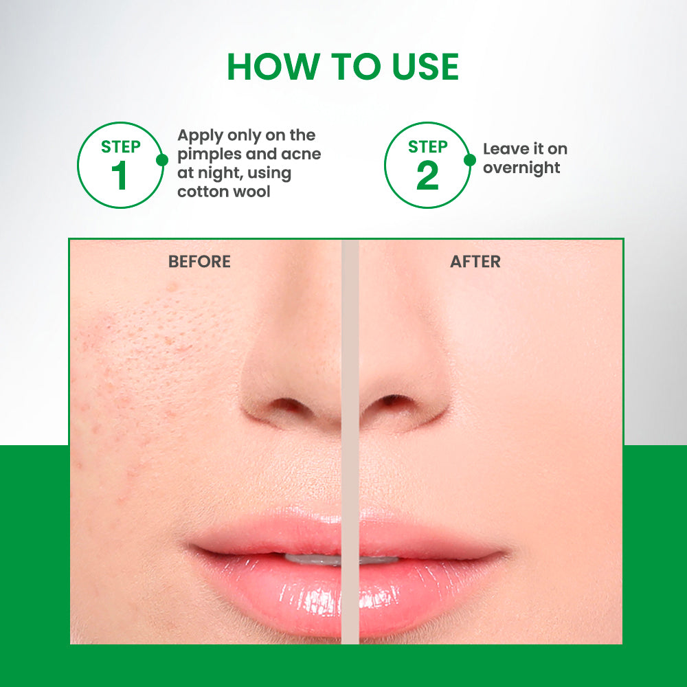 Shaclear Plus Skin Clear Anti-Pimple Lotion 100ml