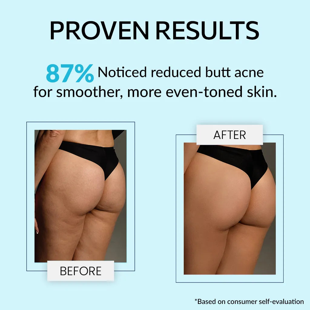 Teenilicious Bum Body Cream with Retistar & Shea Butter for Butt Acne