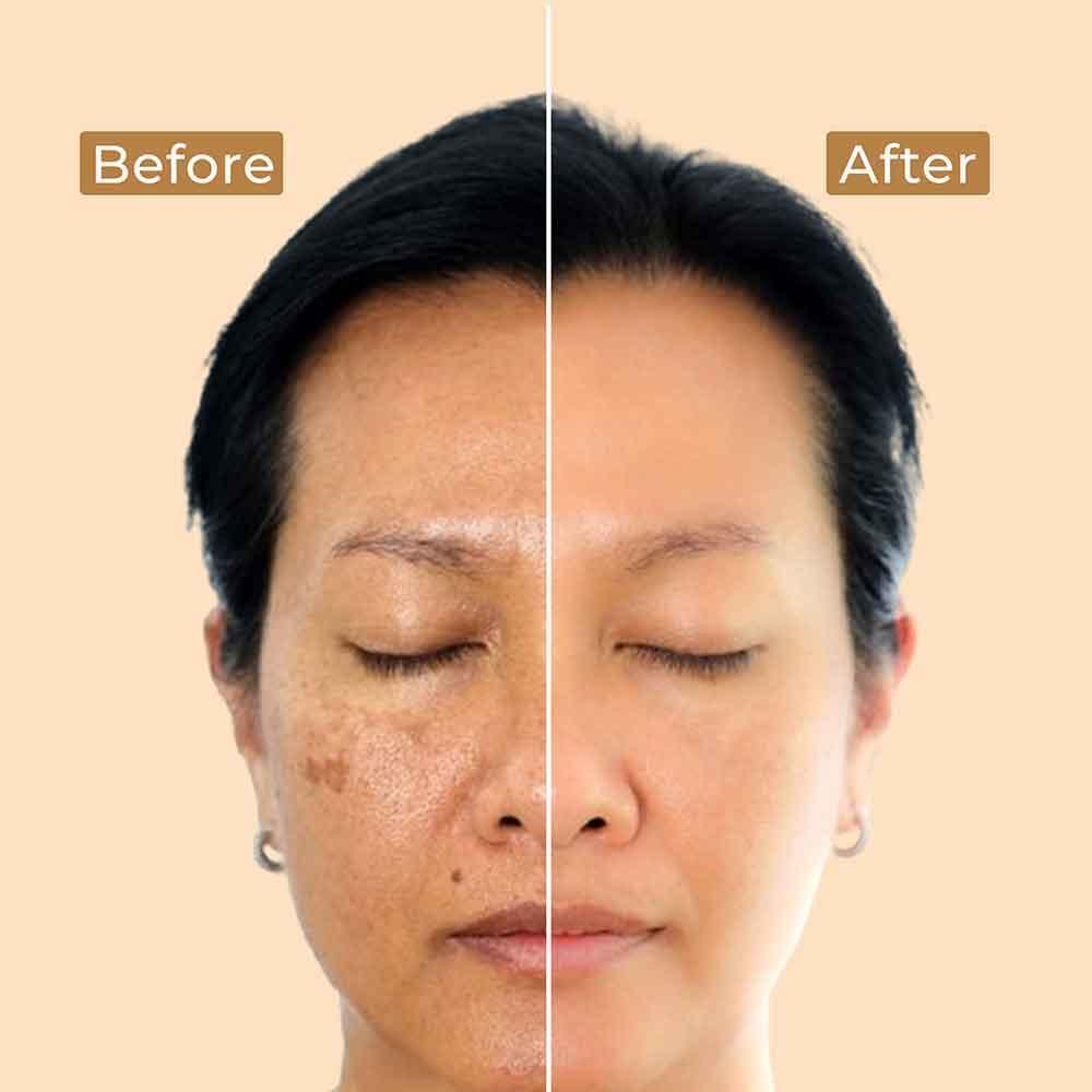 Brightening Depigmentation Gel for Reducing Pigmentation, Dark Spots and Blemishes With Cow Yogurt & Mashobra Honey - Pack of 2